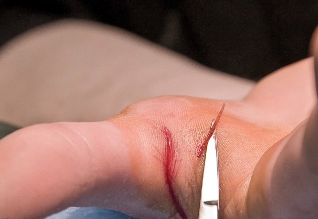 Antibiotik iz prirode: Ova namirnica brzo sanira ranu od posekotine